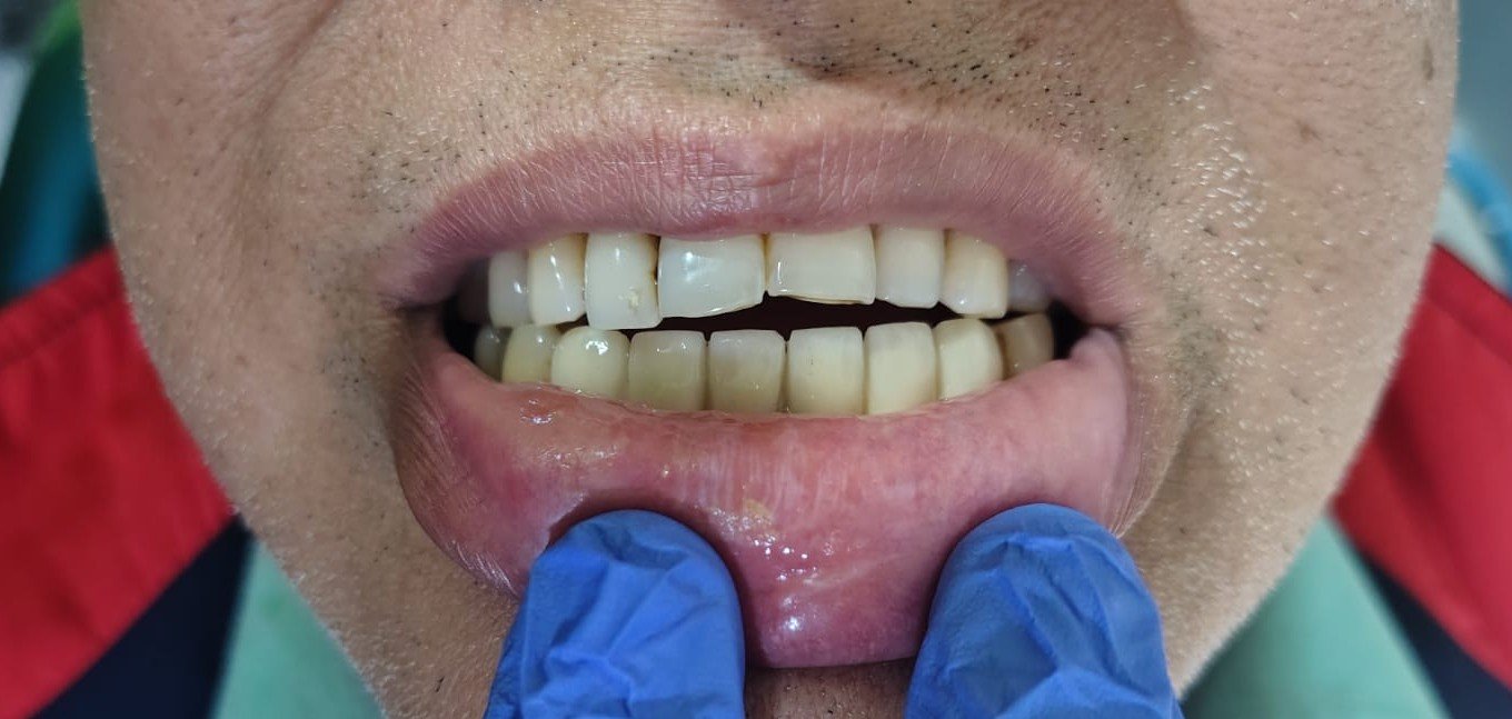 After treatment